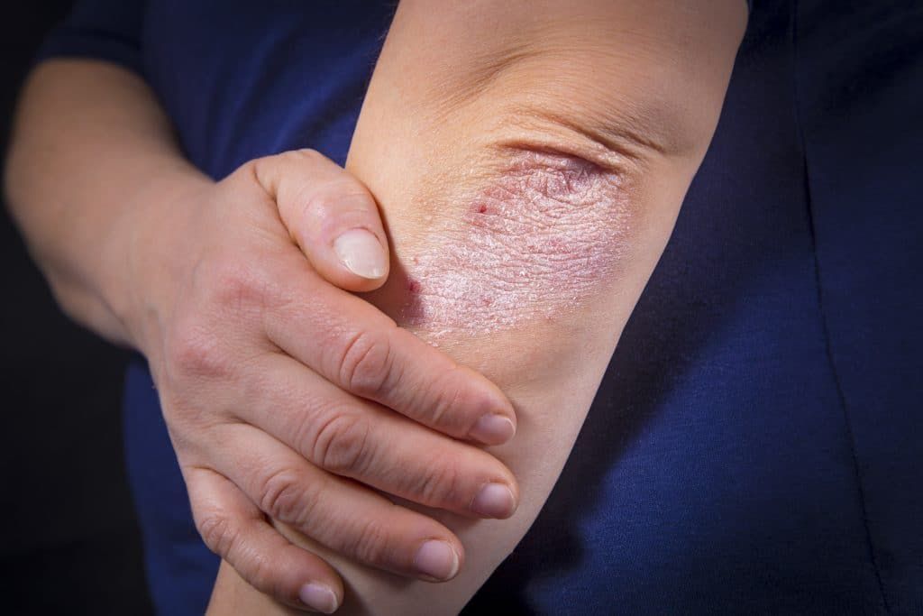 Is psoriasis contagious?